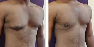 Grade 1 Gynecomastia- Before and After Treatment