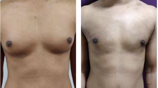 Grade 2 Gyno- Before and After Treatment