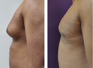 Grade 3 Gynecomastia - Before and After Treatment