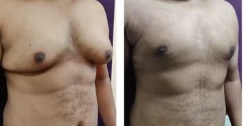 Grade 4 Gyno- Before and After Treatment