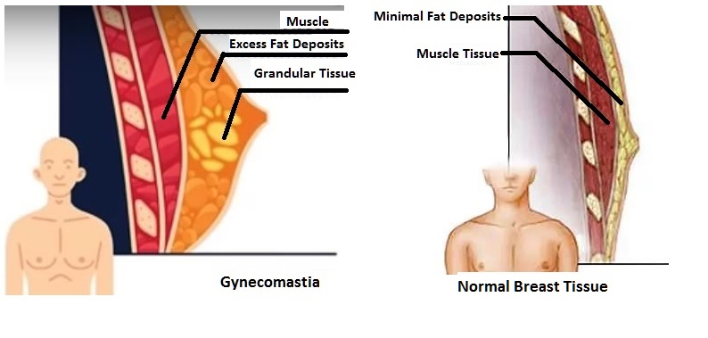 Gynecomastia and Normal Breast Tissue