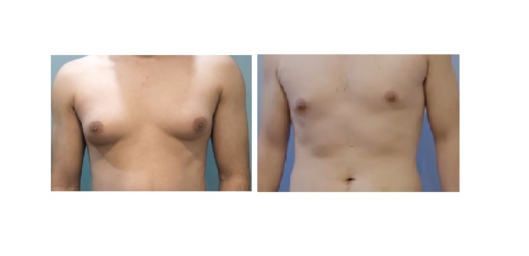 Can You Be Skinny With Gynecomastia?