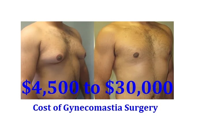 What is the cost of gynecomastia surgery?