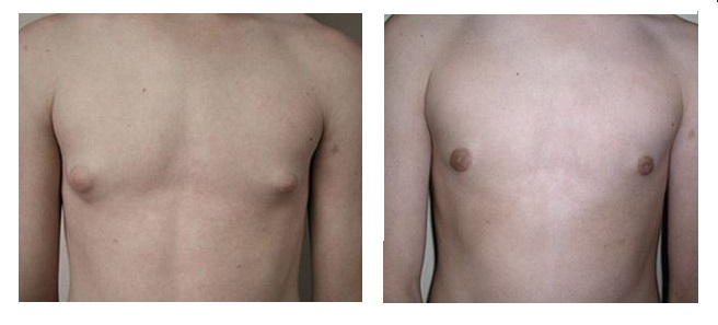 Can Gynecomastia Come Back After Surgery