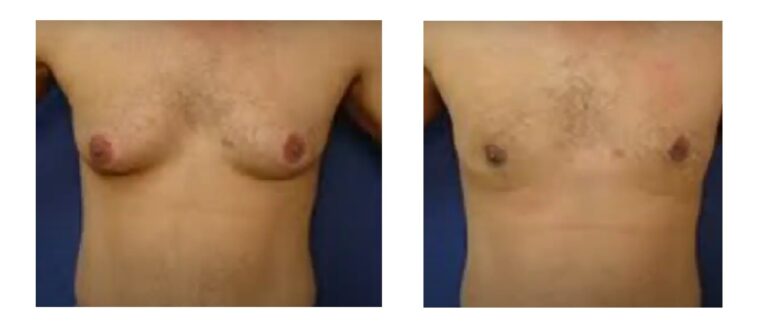 Gynecomastia Treatment Without Surgery – Is It Possible?