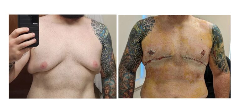 How Much Does Gynecomastia Surgery Cost?