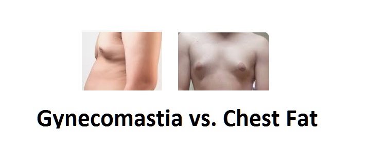 The Differences between Gynecomastia vs. Fat