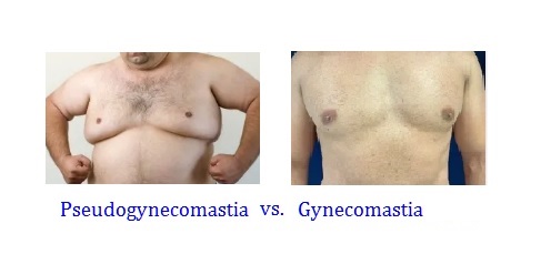gynecomastia vs. pseudogynecomastia