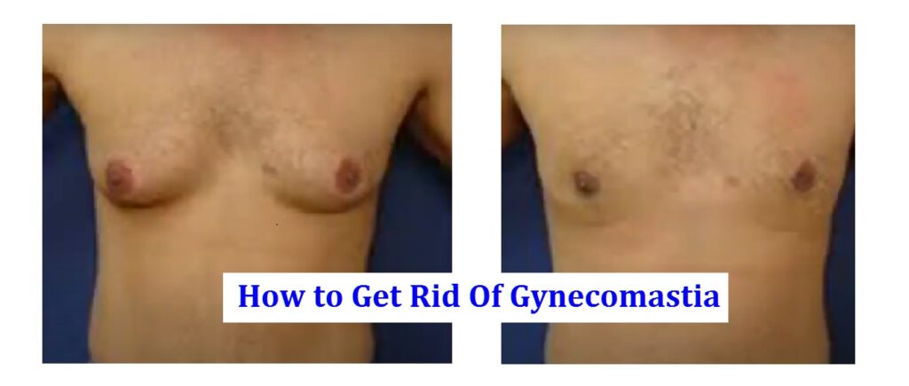 How to Get Rid Of Gynecomastia