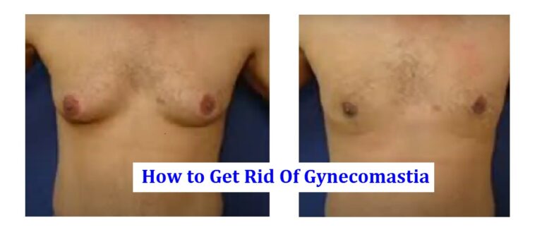 How to Get Rid Of Gynecomastia – Medical and Natural Remedies