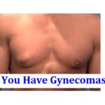 How to Tell If You Have Gynecomastia or Just Fat