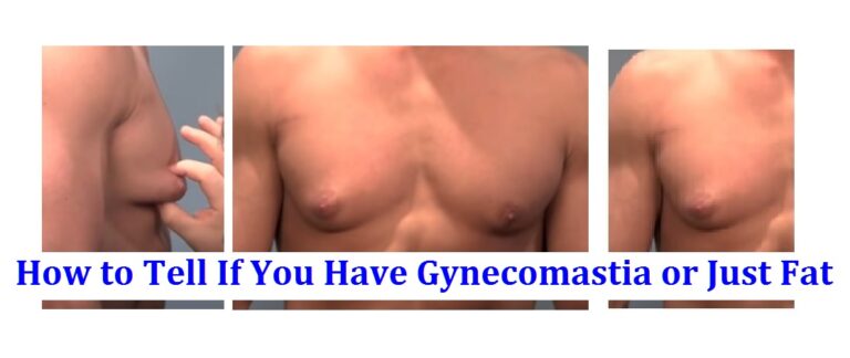 How to Tell If You Have Gynecomastia or Just Fat