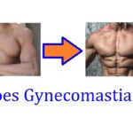 when does gynecomastia go away