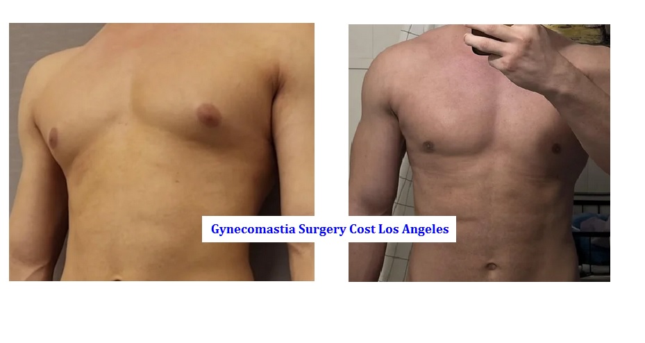 gynecomastia surgery cost los angeles